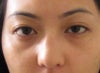 left eyelid ptosis?