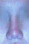A few months after surgery, I can see the same problem beginning to happen. I went back to the doctor weeks ago and he admitted that the nose was shifting yet again and that this was because my nasal bones were crooked in it of themselves. He told me that the ONLY permanent solution for this was to break my nasal bones, wait for it to heal and then insert a new implant in.
