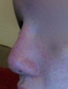 Even with the Restylane, the deviation is apparent and the gap where the silicone stops and cartilage begins is visible. I don't know what to do anymore.