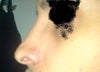 slightly upturned and alar retraction/bossae/notching?.
