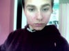 As you can see the redness is mainly around my nose, mouth, chin, and part of my right cheek.  There is still large parts that have not began to peel yet (forehead and other parts of cheek).