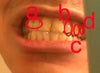 a, i have some dark stains near the top of the two teeth circle and on the back side
b, the corner of my tooth chipped off
c & d, are eroded real rough on the outside
my 2 front teeth have large fillings out the outside and discoloration
b&c&d that side of my mouth no longer fits together properly