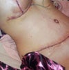 my tummy tuck 2 days after