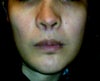 The columella fell a little, and the base of my nostrils were reduced but not the height and the width.Its difficult in my case to do that? thankyou.