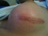 Scar close up - as thick as my fore finger, very itchy and flakes a bit