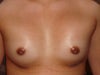 4 Days Post-Op