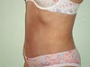 4 1/2 weeks post-op side