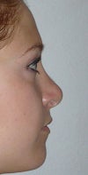 Nose Side