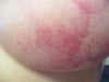 blue/red bruised appearance caused by venous congestion