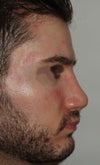 after revision - 9 months. Profile looks exactly the same as it did before revision
