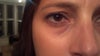 Dark Circles