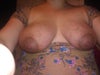 Tuberous breast.