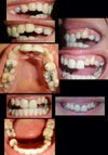 two front teeth as well as a pre molar at the top are crowned. Two missing molars at the bottom which were removed as a child. Bridge work on one side.