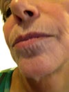 Lower Face