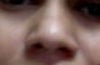BEfore alar base reduction and tip refinement