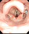 Nasal pharyngeal airway open