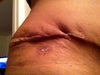 right side of hip.....wrinkly...will this resolve?i thought with the lipo it should not look like this.what about the scar sticking out?