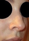 This is the worst angle.  The bump on my left side is very noticeable and my nose looks huge.