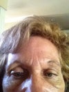 Lumps above each eye, worse above left eye