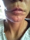 Fat transfer above lip seems to have moved downward