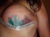 5 or days after surgery