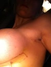 yellowish shadow around boob