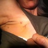hematoma underarm from drainage