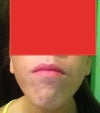 I tried taking one close up to get a good view. My chin does this every time my mouth is closed. My own sister told me it "wrinkles up into a ball"