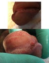 During the procedure - Bottom area is part where I am experiencing the most pain - all around is hypersenstive, but this is actually sore, and it aches/burns (right side of glans)