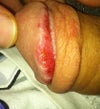 Day 9. From about day 15 it started looking fine, the cosmetic aspect of treatment was successful.