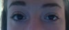 As you can see there is a large difference between my left and right sides of my face. Also becomes worse when i smile.
