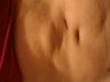 This was taken August 2012, 4 months after the 1st procedure.