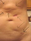 Another one after the first procedure, with arrows pointint out the problem areas, and the burn scar. The raised area in the center is scar tissue from the internal burns.