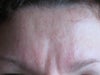 Me frowning (4 wks after 1st treatment 42 units + 12 days after 2nd treatment 10 units)