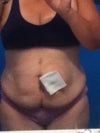 front view stoma covered