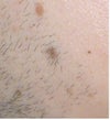 These are the worst moles I have.