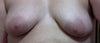 Notice the left breast is lower than the right and the nipple no longer points the right direction