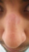 my nose and the burn