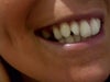 Where the partial denture is usually closing..