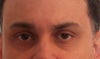 drooping eyebrow