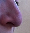 My nose as of now after "correction" of the pollybeak. Will the tip raise? Does this look normal to you, is there the angular tip somewhere under the skin waiting for me? I am just desperate. Was is a wrong decision to correct the pollybeak only 7 months after the revision rhinoplasty?
