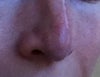 This is slightly more straight picture. If you look at my nose from the front, the shadow form above the nose, and looks like I do not have the tip at all or it is drooping.