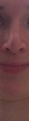 Bad resolution, but this is my nose before the pollybeak was corrected, you can see no actual tip but larger tip area that starts from the supratip area, from the highest part of the nose. I cannot see much difference to the nose I have now. I have spend years to wait to the the nose and now I feel the whole thing just ruined my beautiful face. Please tell me what to do, wait, talk to the doctor, ask for more steroids. IS the stroid melting the tip support or what?