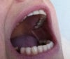 Metal showing from implant crowns along gum line (back 3 upper)