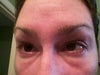 3 months post