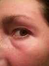 3 months post