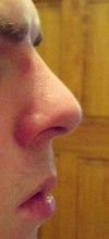 My nose today, continuous daily congestion and breathing problems. Very uncomfortable.