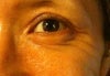 deep wrinkles with big smile