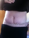 14 days po huge hernia and lipo extensive transparent facia and diastasis..you can see more at my profile