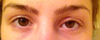 First Ptosis Repair